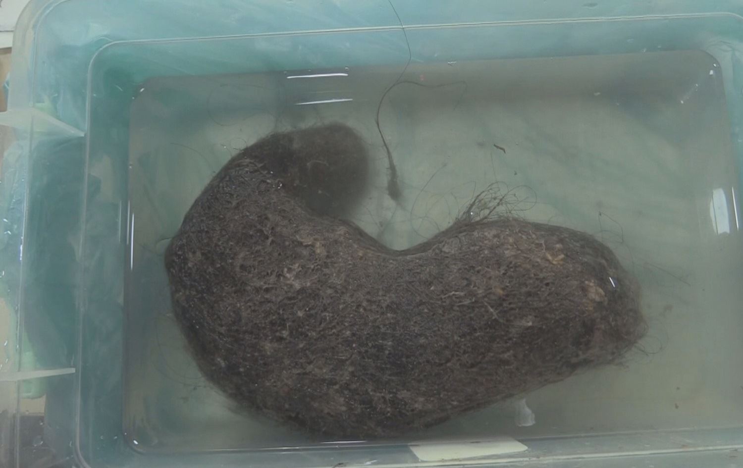 Li Sêrtê kîlo û nîv mû ji mîdeya jinekê hat derxistin