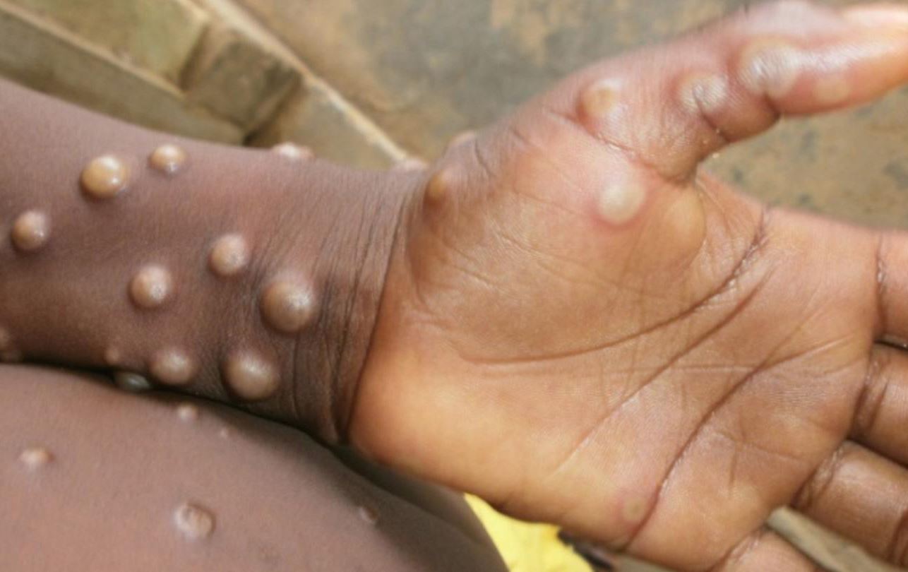 ئایا هاوڕەگەزخوازان تووشی سورێژەی مەیموون دەبن؟