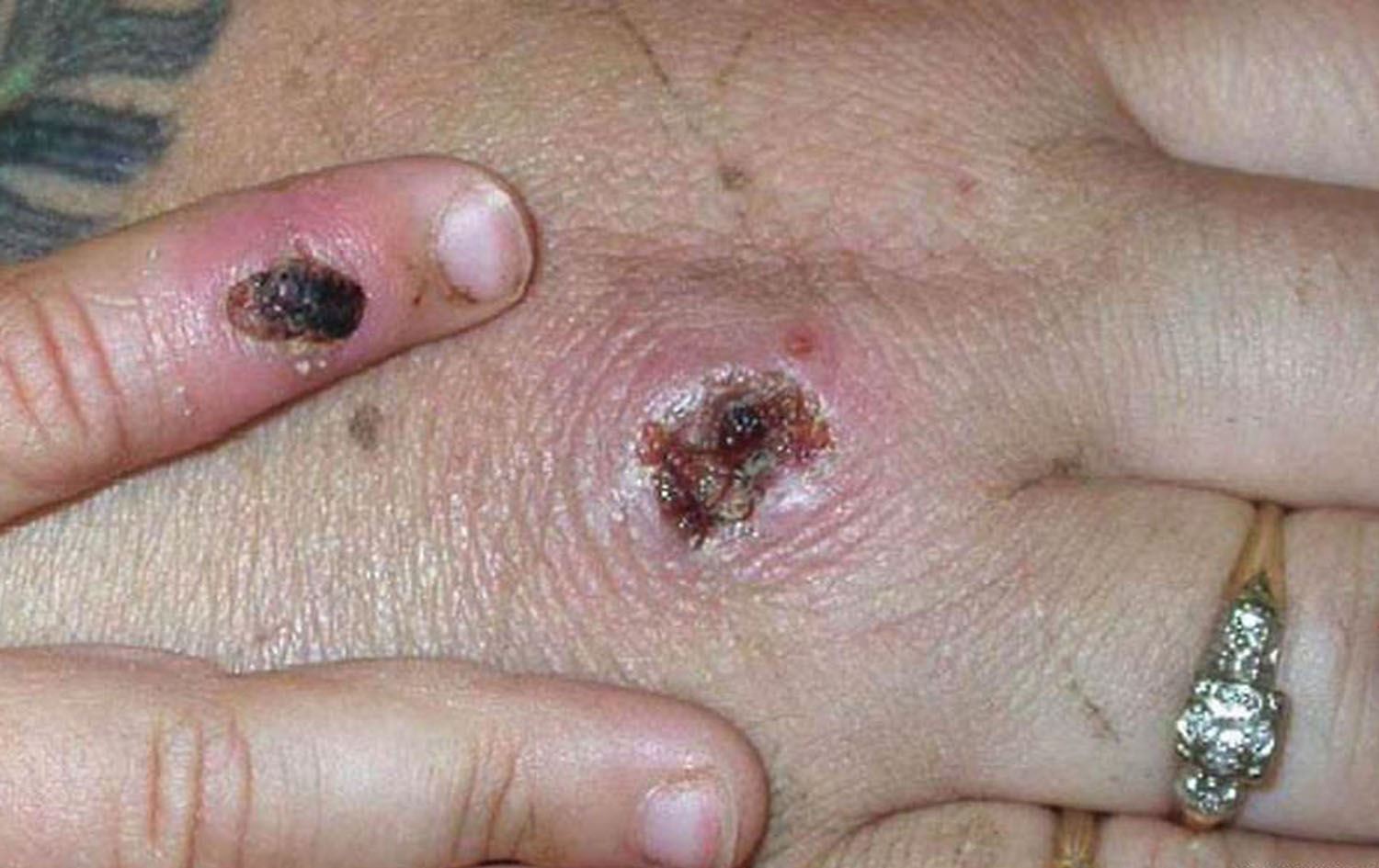 زیاتر لە 700 توشبووی ئاوڵەی مەیموون لە جیهاندا تۆمارکراون