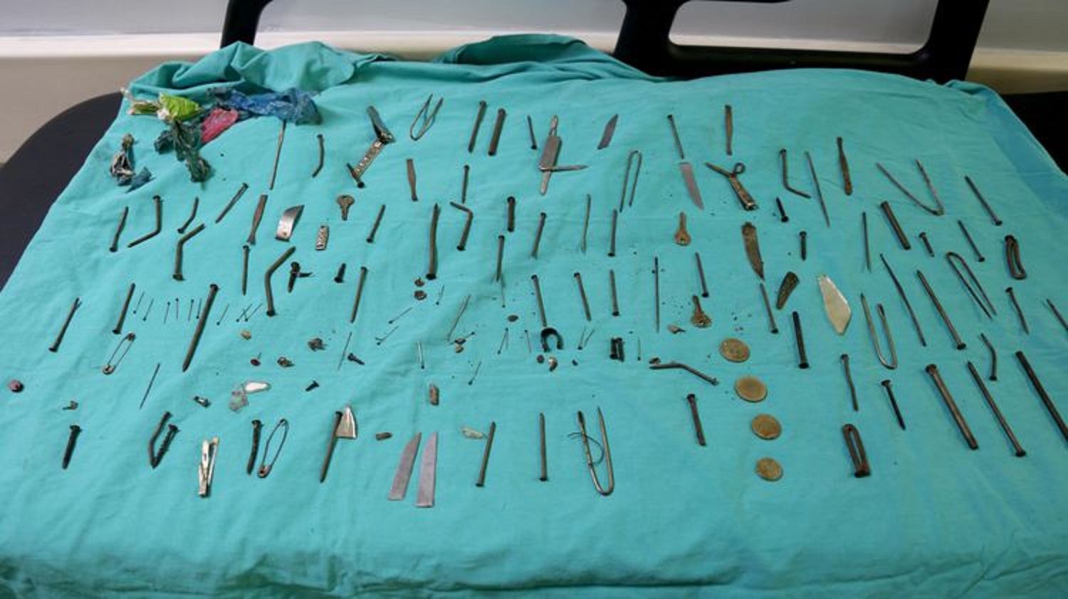 Van'da kadın hastanın midesinden 158 yabancı cisim çıkarıldı