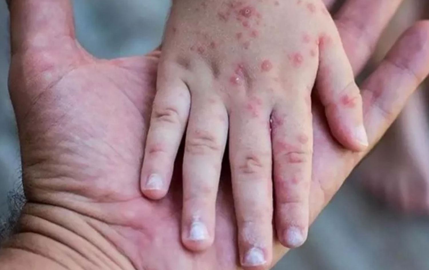 ABD'de üç eyalette daha maymun çiçeği nedeniyle acil durum ilanı