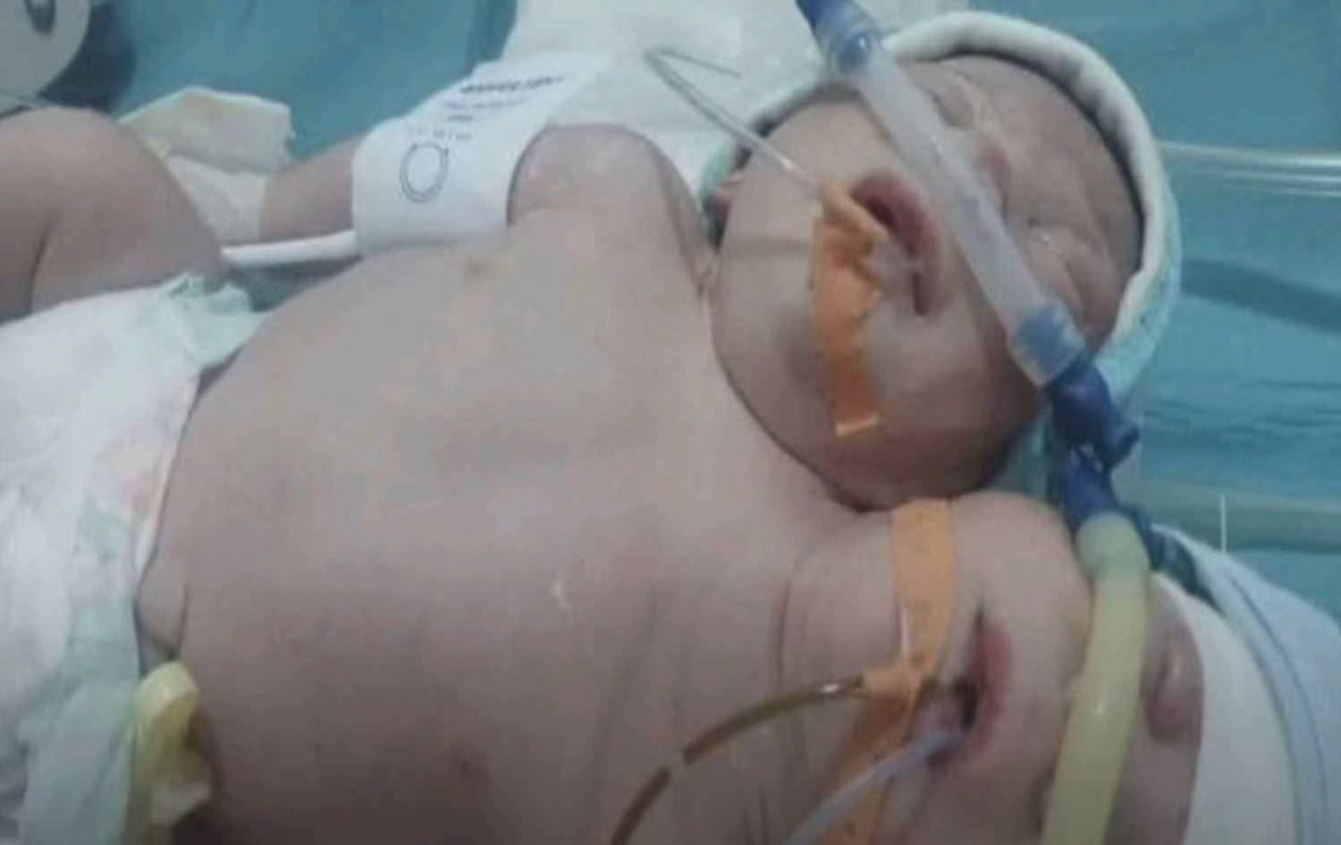 Li Idlibê zarokek bi 2 seriyan ji dayîk bû