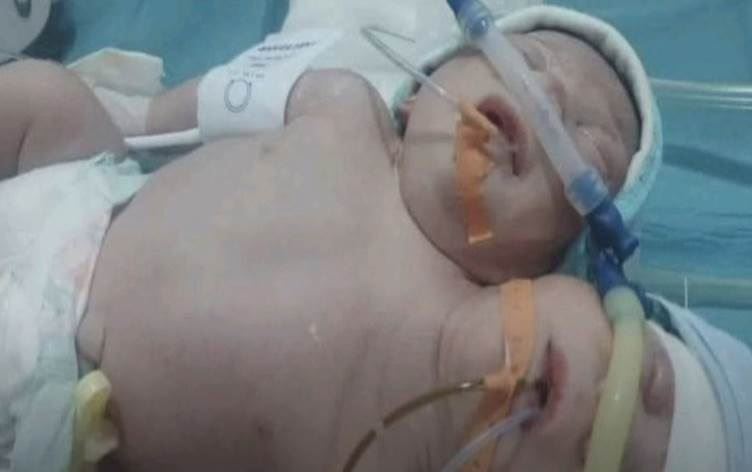 İdlib’de üçüncü defa çift başlı bebek doğdu