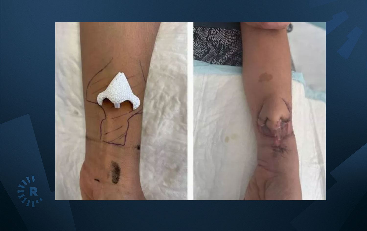 Kanserle savaşıyordu, kolunda burun gelişti