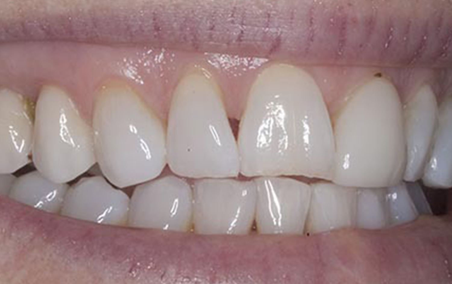 زانکۆی بۆستن لە ئەمریکا: جگەرەی ئەلیکترۆنی بۆشایی نێوان ددانەکان فراواندەکات