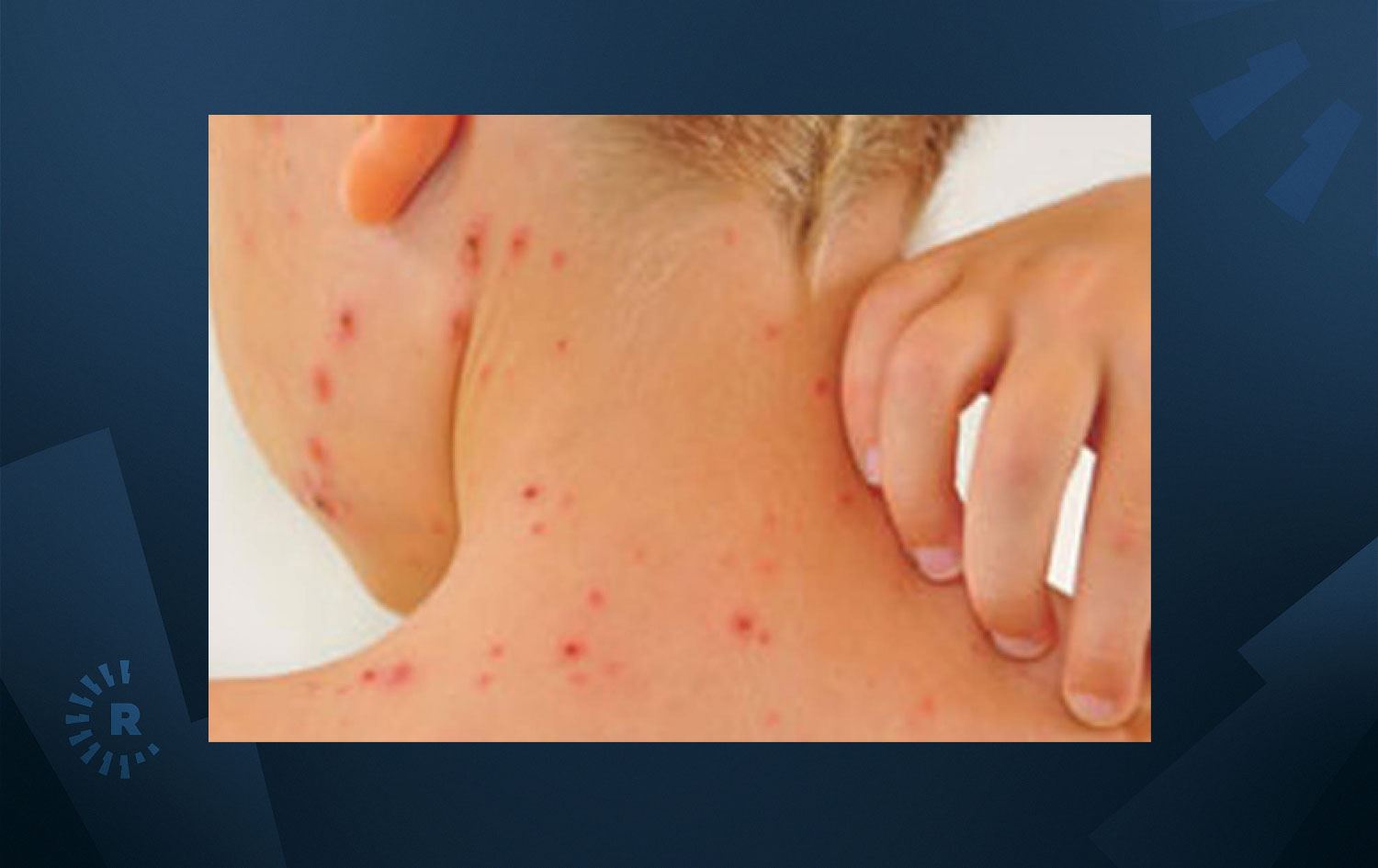 Yaklaşık 40 milyon çocuk kızamık tehlikesiyle karşı karşıya