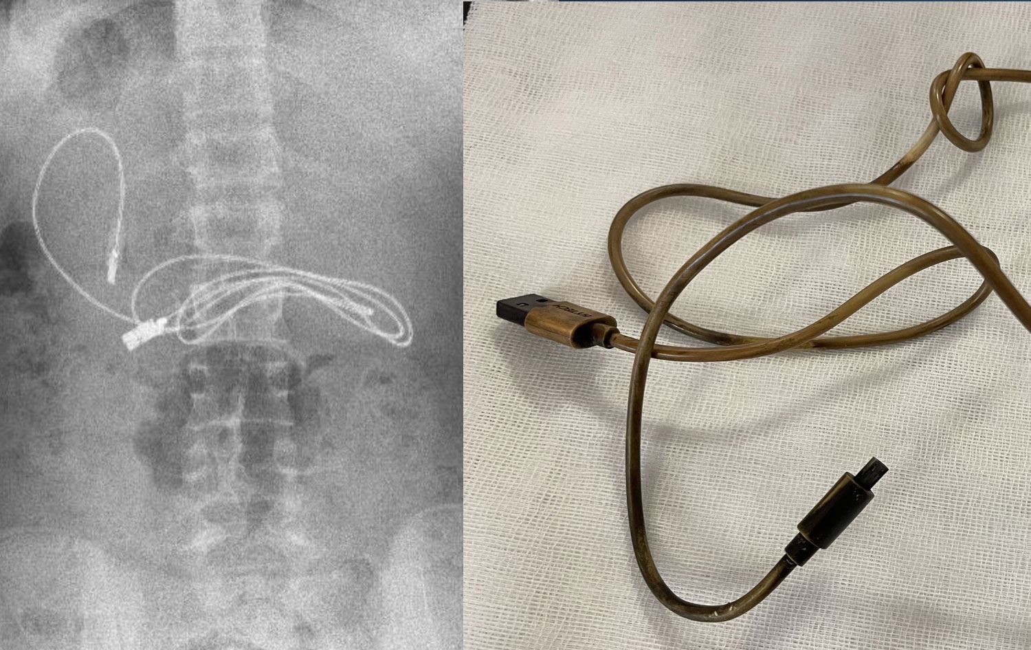 DİYARBAKIR- Midesinden bir metrelik şarj kablosu ve toka çıktı!