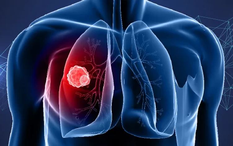 تەندروستیی هیندستان: ئەمساڵ ژمارەی تووشبووانی شێرپەنجەی سییەکان 5% زیادیکردووە