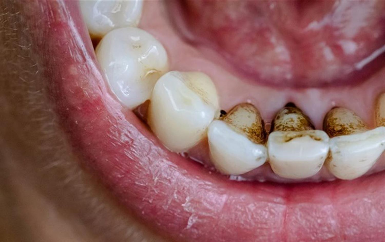 پزیشکێکی پسپۆڕی ددان لە ئەمریکا چەند هۆکارێکی رەشبوونی ددانەکان رووندەکاتەوە