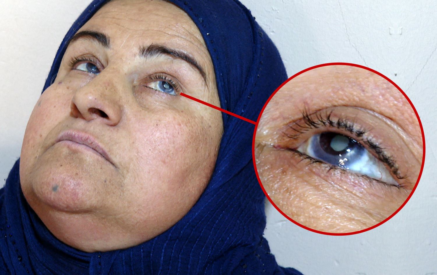 چیرۆکی بەرکەوتوویێکی چەکی کیمیایی و شکستهێنانی دوو نەشتەرگەریی چاوی