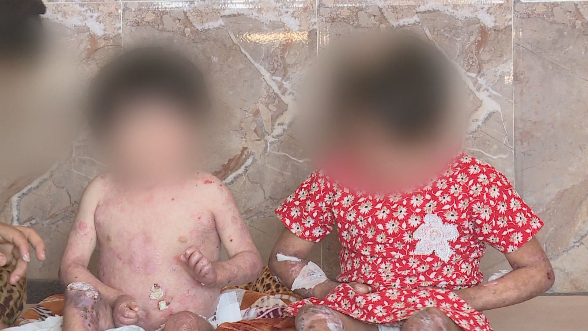 دوو خوشک لە هەولێر بەدەست نەخۆشییەکی دەگمەنی پێست دەناڵێنن