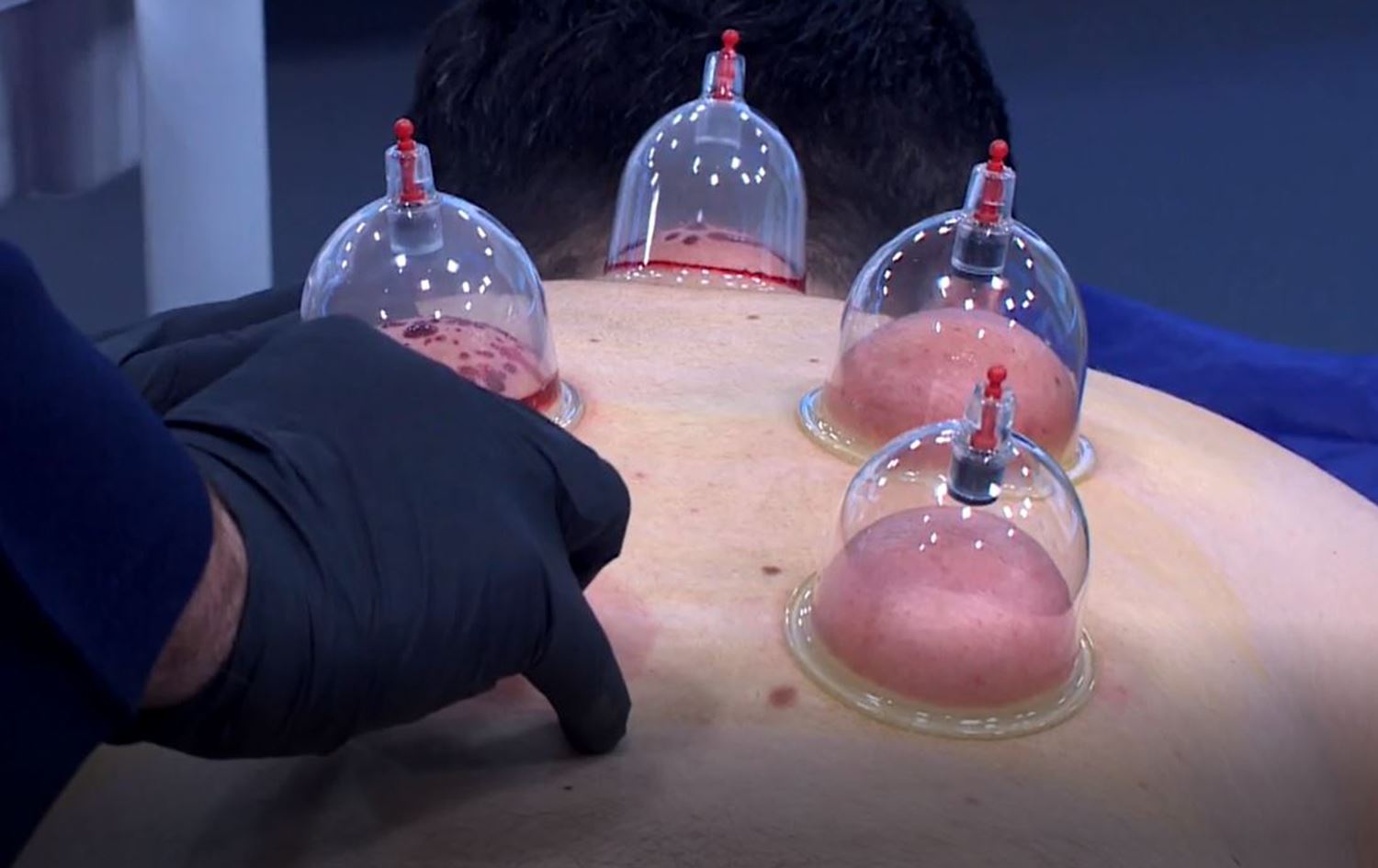 بەرنامەی دکتۆر ئاراس رای زانستی پزیشکی لەسەر کەڵەشاخ ئاشکرادەکات