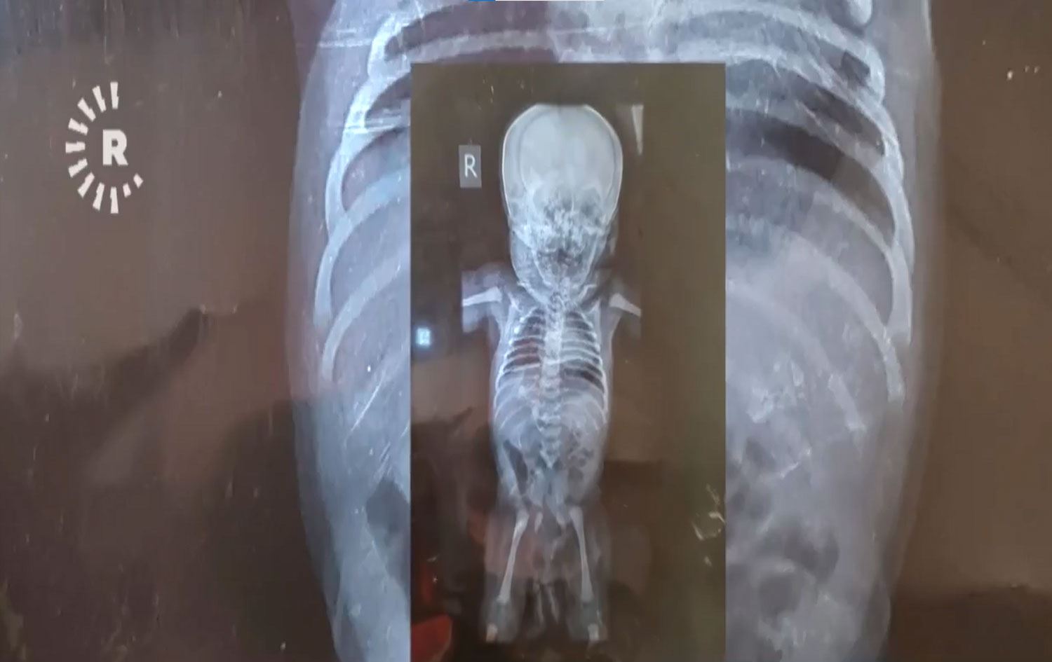 Kanı kahverengi, kalbinde 6 delik; Mucize çocuğun tüm organları başka yerde