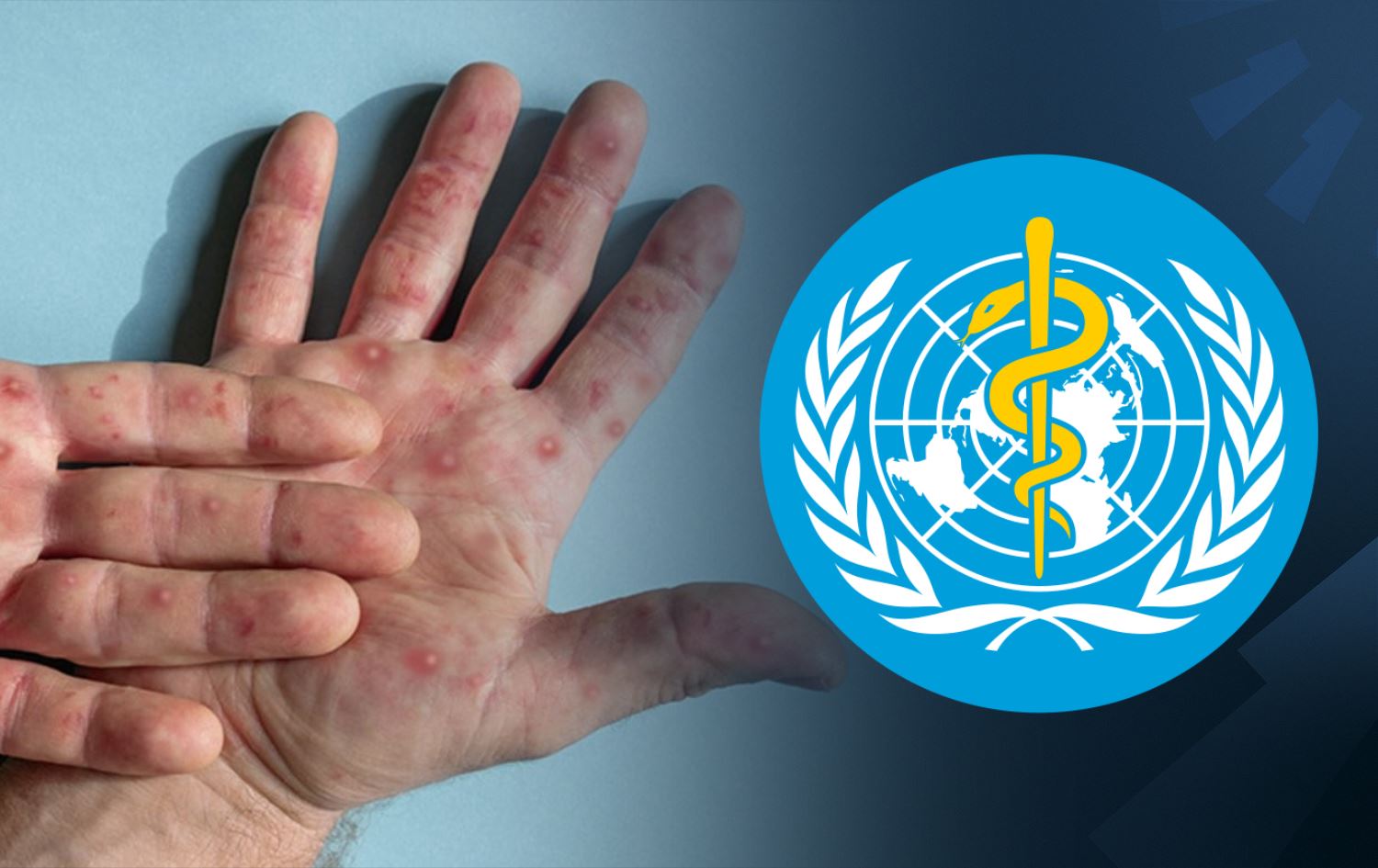 تەندروستیی جیهانی: ئاوڵەی مەیموون چیدیکە بارێکی لەناکاوی تەندروستی نییە