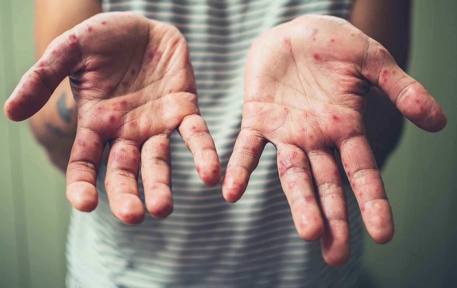 Li ser belavbûna Sorikan hişyarî; Nexweşî  zêde dibe û zarok dimirin