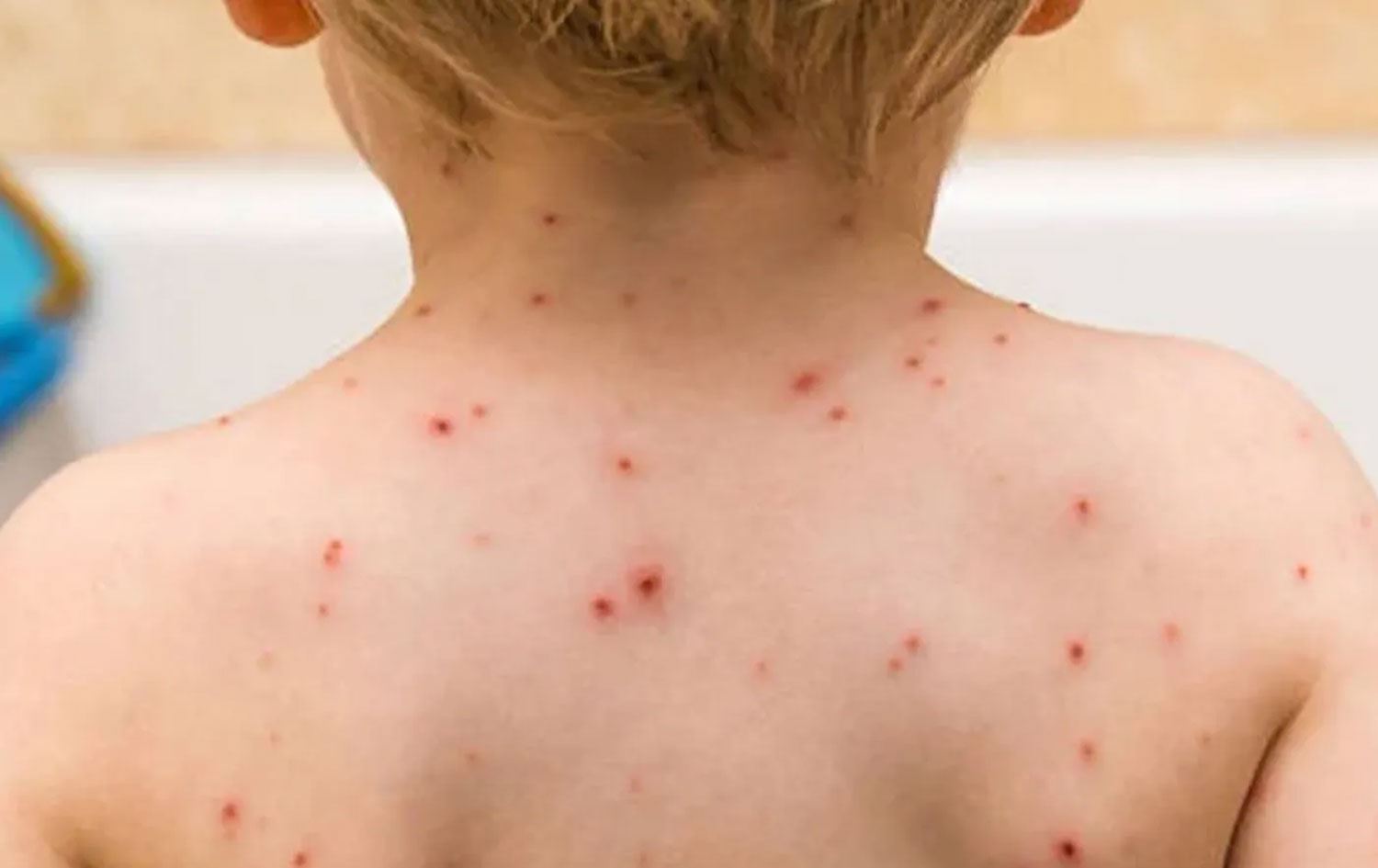 Kızamık hastalığına yakalanan çocuk