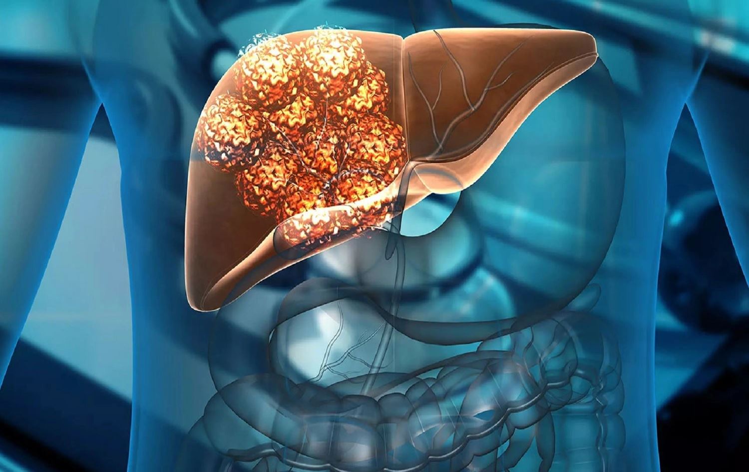 Li Tirkiyeyê di salekê de 41 hezar kes bi nexweşiya penceşêra kezebê ketine