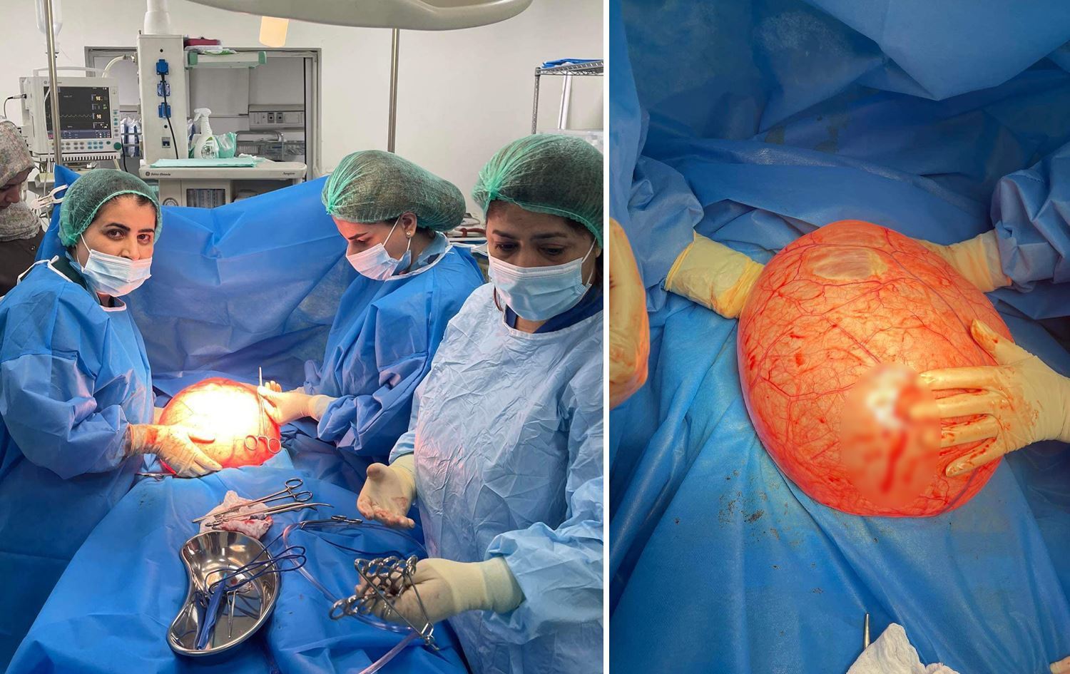 Dema kîst hatiye derxistin / Nexweşxaneya Jinan a Silemaniyê