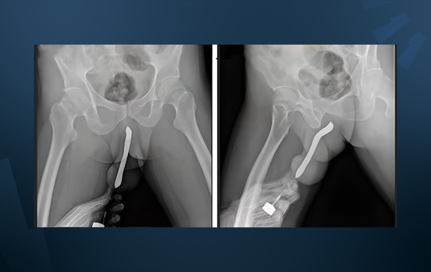 Wêne: International Journal of Surgery Case Reports