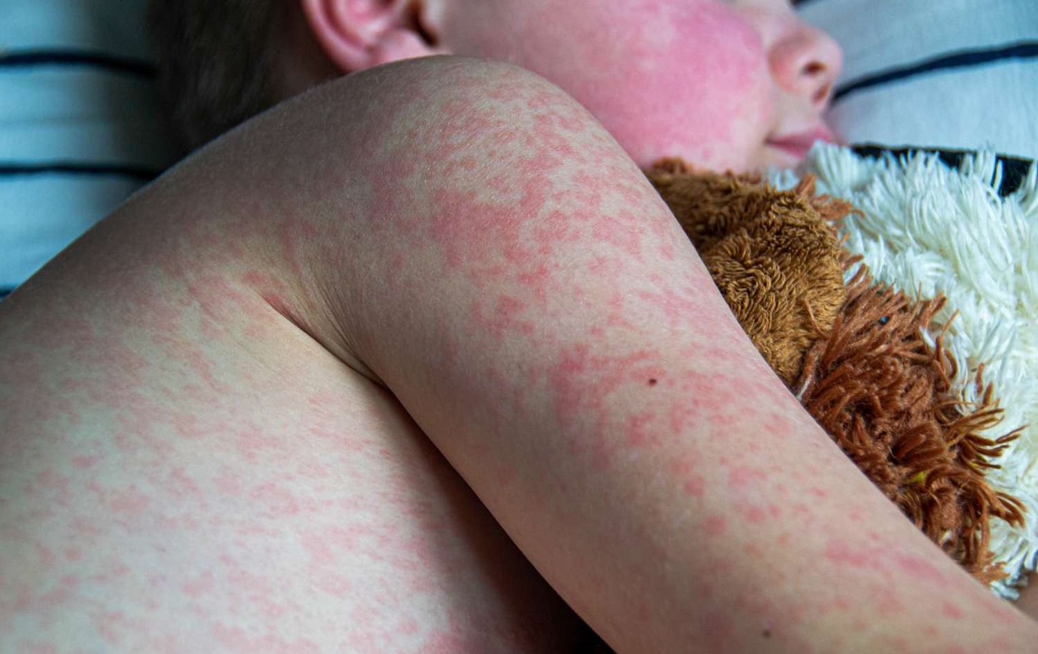 تەندروستیی جیهانی: سوورێژە بەراورد بە ساڵانی رابردوو زیاتر لە جیهاندا بڵاوبووەتەوە