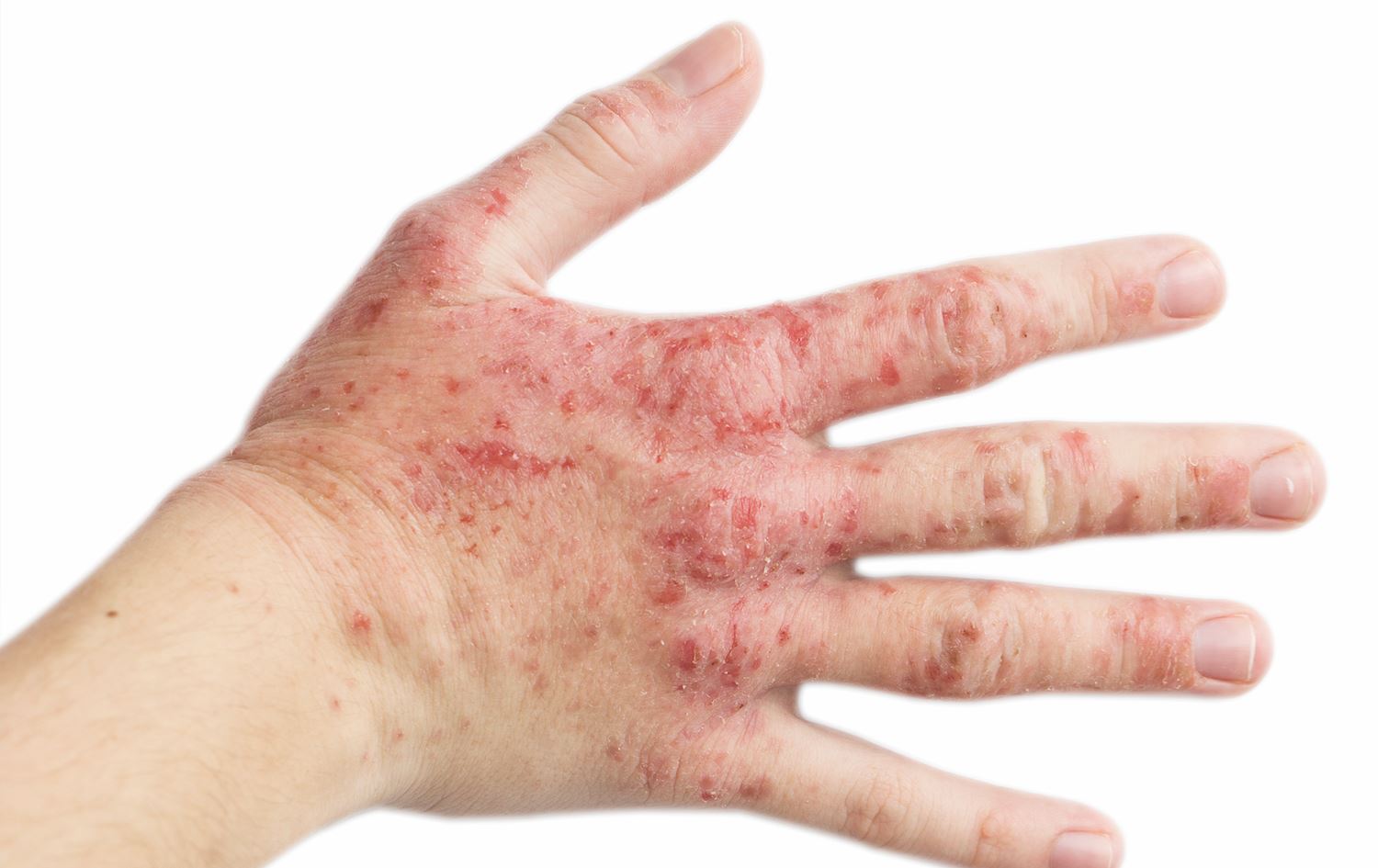 توێژینەوەیەک: ئەو دایک و باوکانەی ڤەیپ دەکێشن، منداڵیان بۆ ئەکزیما ئامادە دەکەن