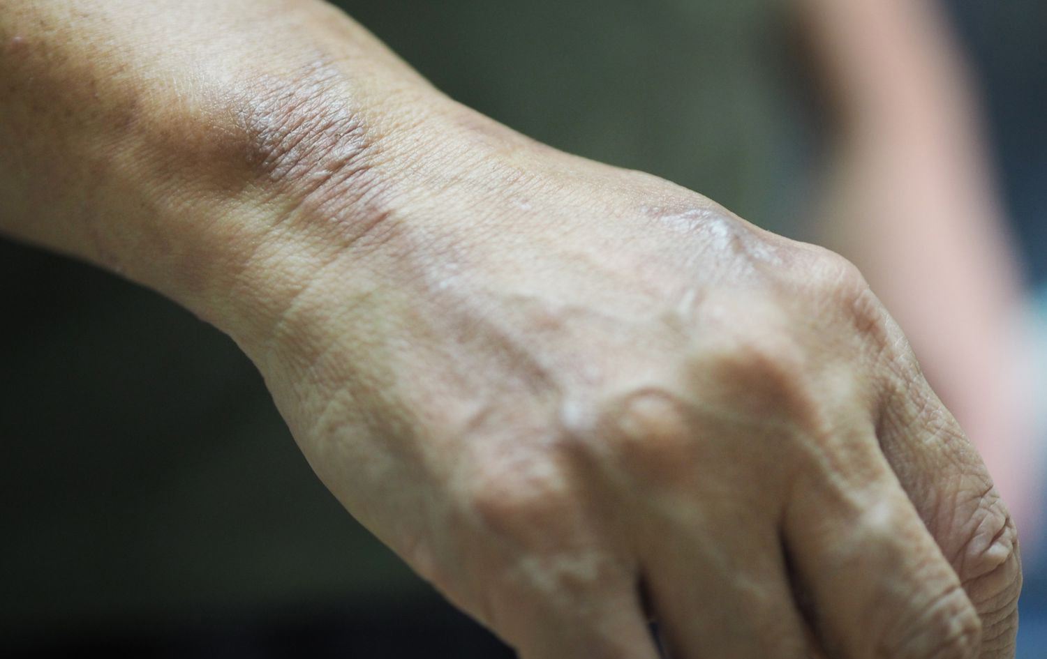 دەنگۆی بڵاوبوونەوەی نەخۆشیی گولی لە ئێران بڵاوبووەتەوە و وەزارەتی تەندروستی رەتیدەکاتەوە