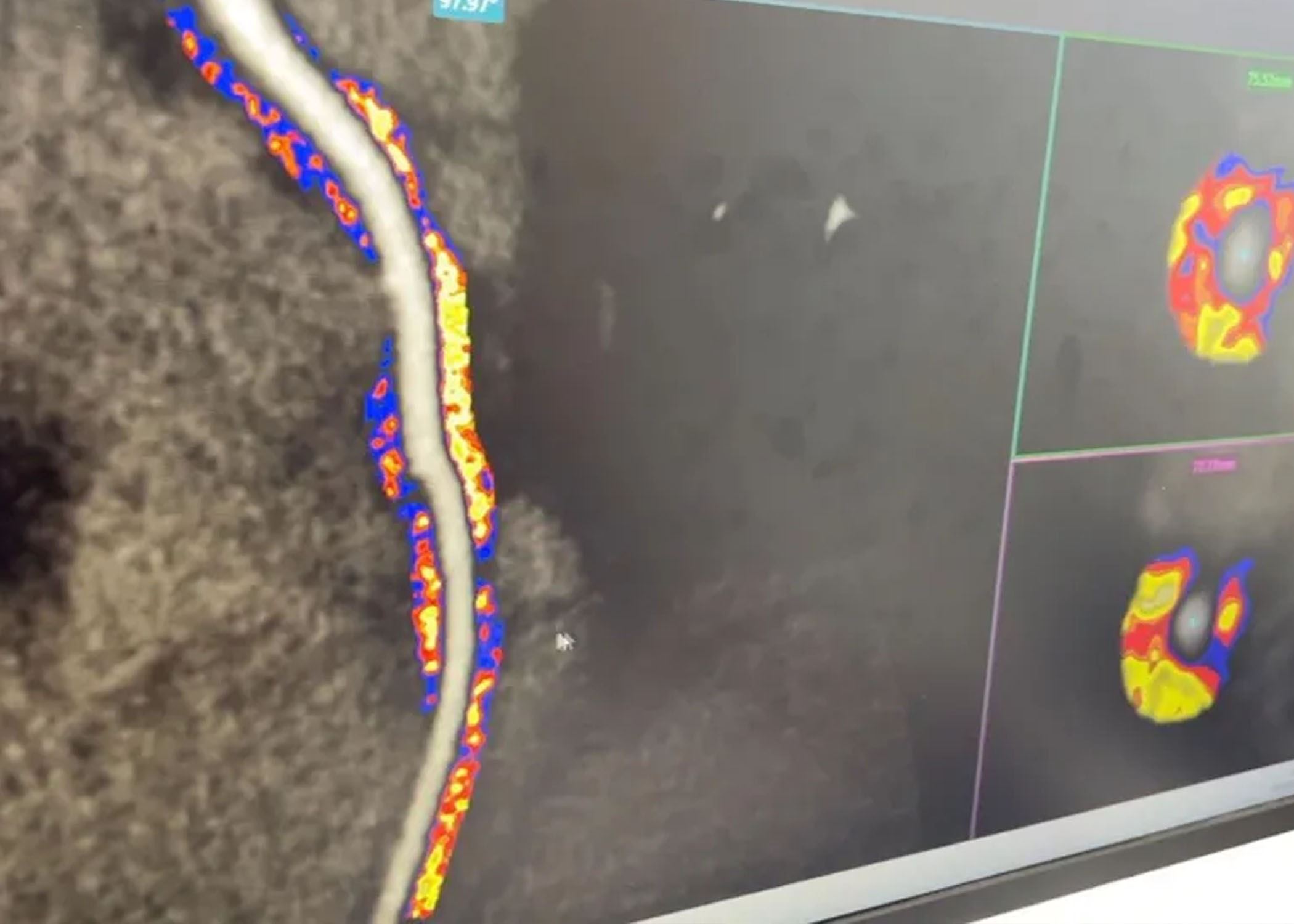 زانکۆی ئۆکسفۆرد: دەشێت بەهۆی ژیریی دەستکرد پێشگیریی لە روودانی جەڵتەی دڵ بکرێت