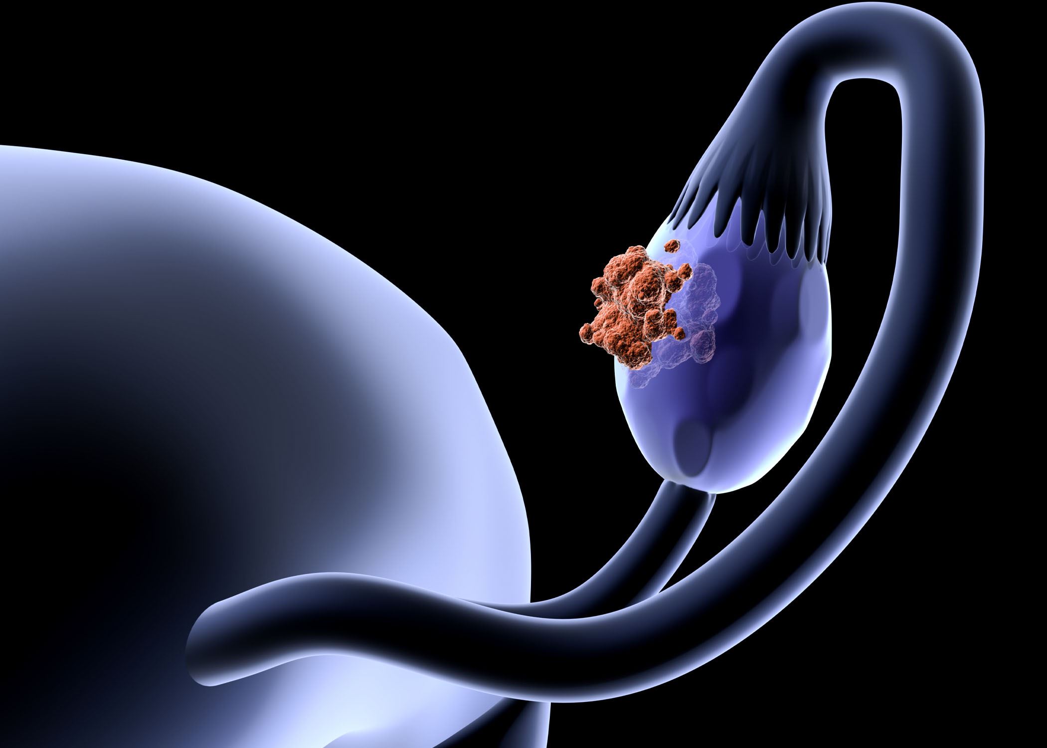 توێژینەوەیەک: پێشوەختە پشکنین ئەگەری گیانلەدەستدان بە شێرپەنجەی هێلکەدان کەمدەکاتەوە