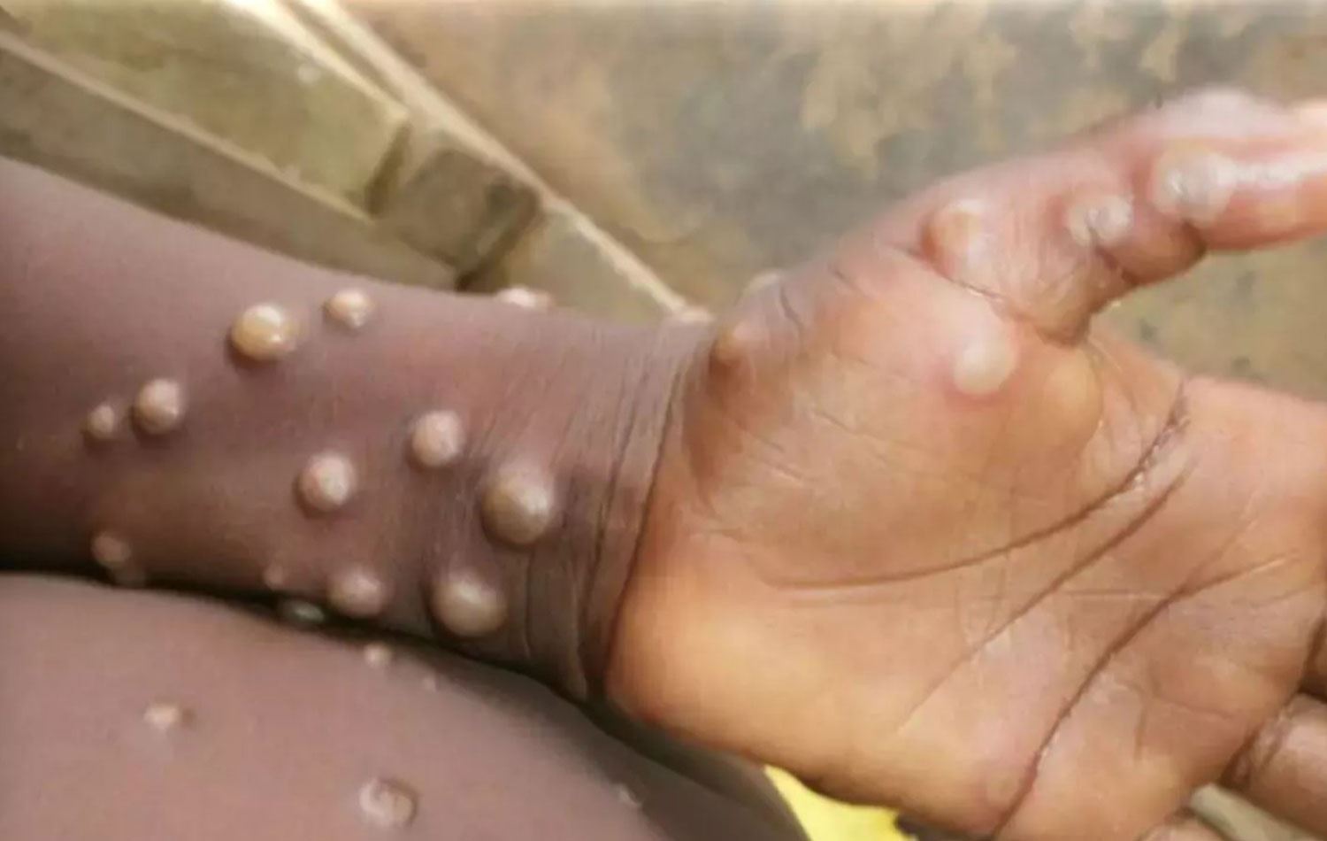 ‘M çiçeği’ hastalığına yakalanmış olan bir kişinin eli. / Arşiv