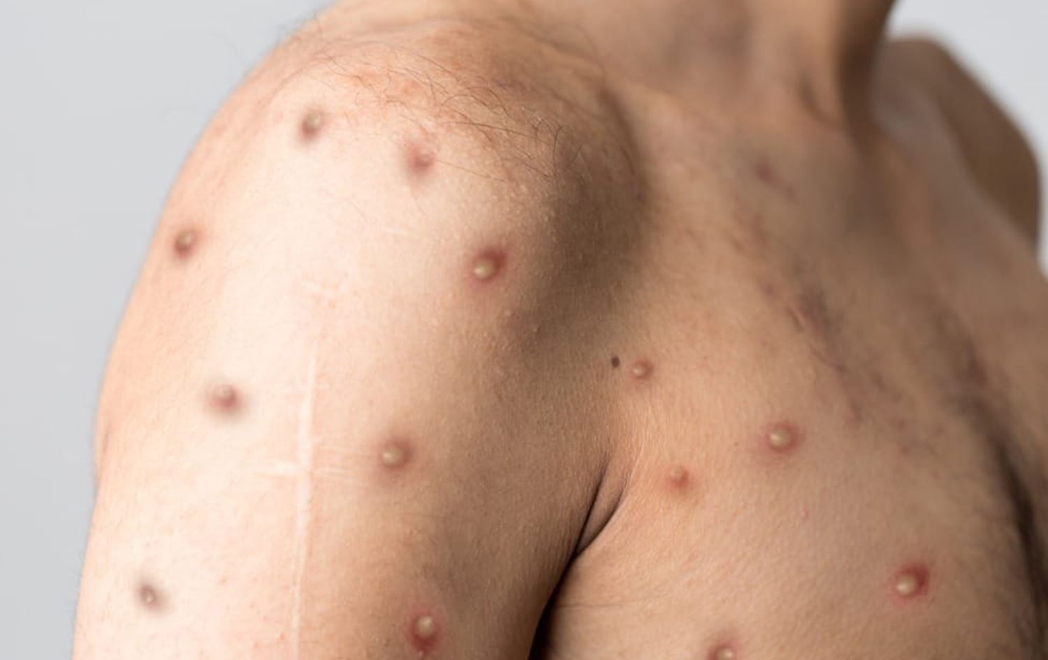 Nexweşekî ku Sorika Meymûnan ketiye / Wêne: Ajans