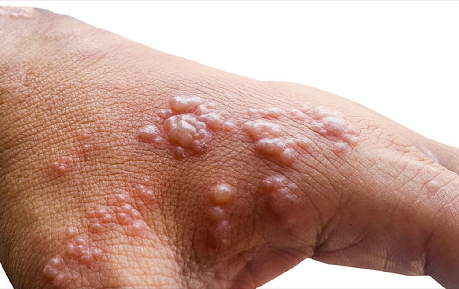 Vîrusa Sorika Meymûnan li Afrîkayê belav bûye / Wêne: Arşîv