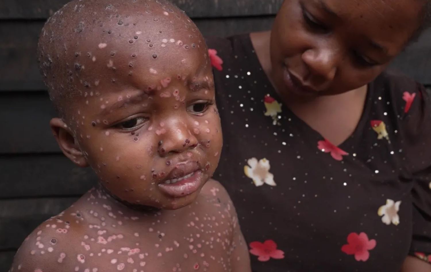 منداڵێکی تووشبووی ئاوڵە. وێنە: BBC