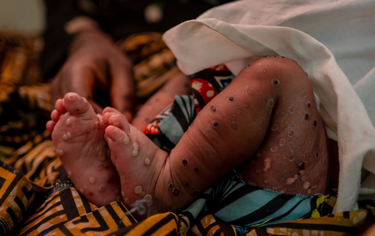 منداڵێکی تووشبووی ئاوڵەی مەیموون. وێنە: Africa News