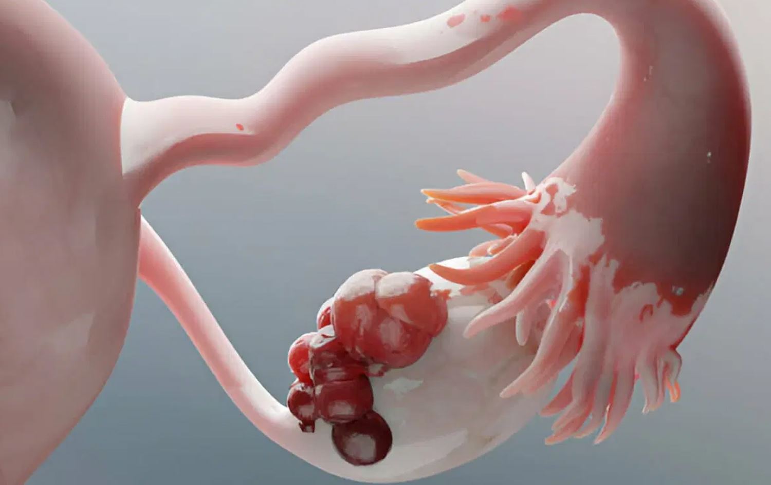 زانکۆی زانست لە نەرویج: قەڵەوی و کیسی هێلکەدان کێشە بۆ کۆرپەلە دروستدەکەن