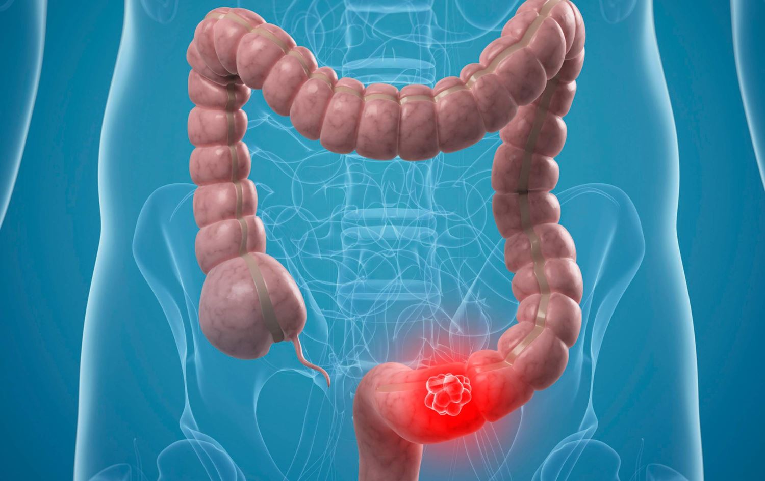 زانکۆی تۆرێنتۆ: کیتۆ مەترسییە بۆ تووشبوون بە شێرپەنجەی ریخۆڵە