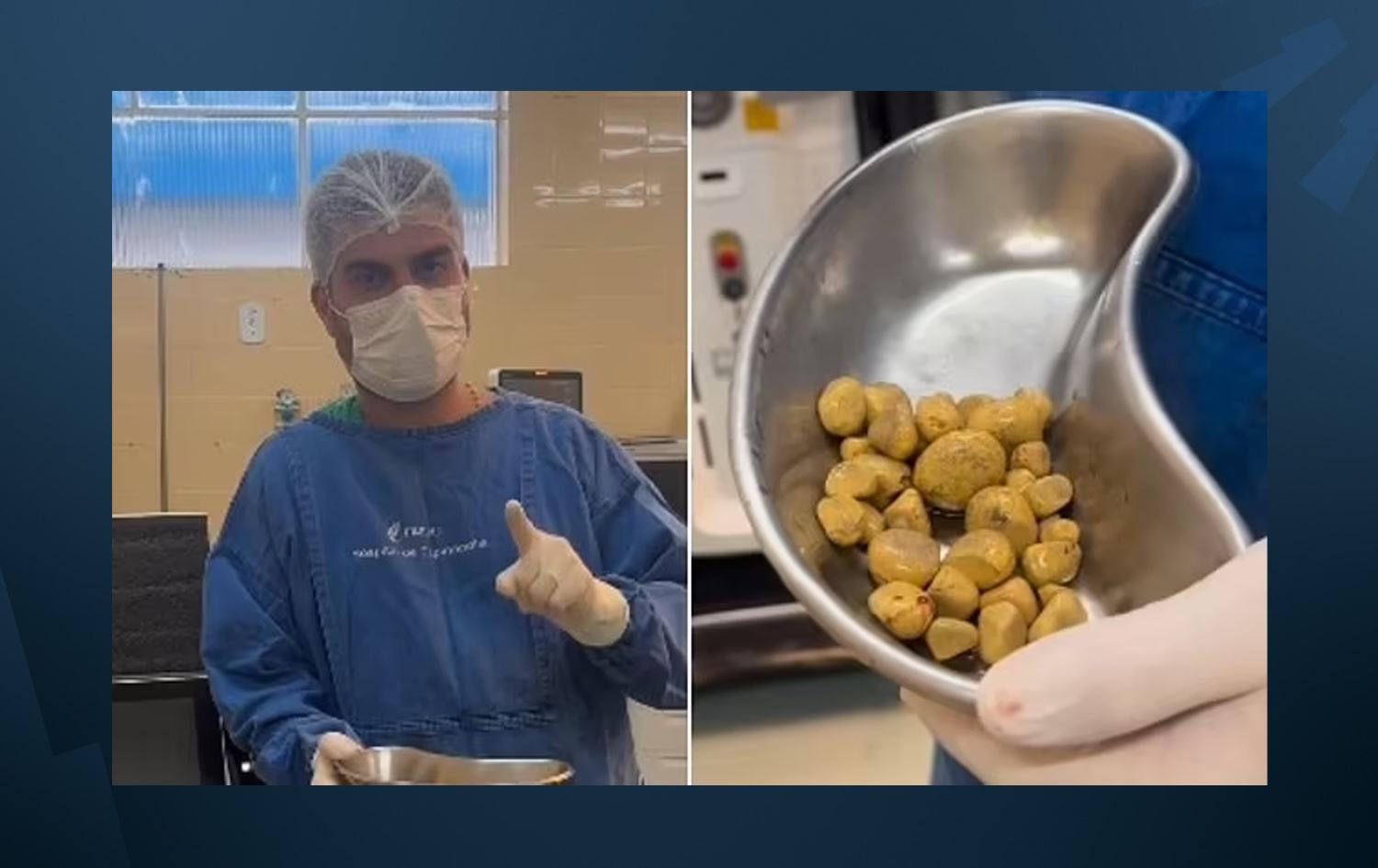 پیاوێکی ئالوودەبووی خواردنەوە گازییەکان، 35 بەرد لە زراوی دەردەهێندرێت