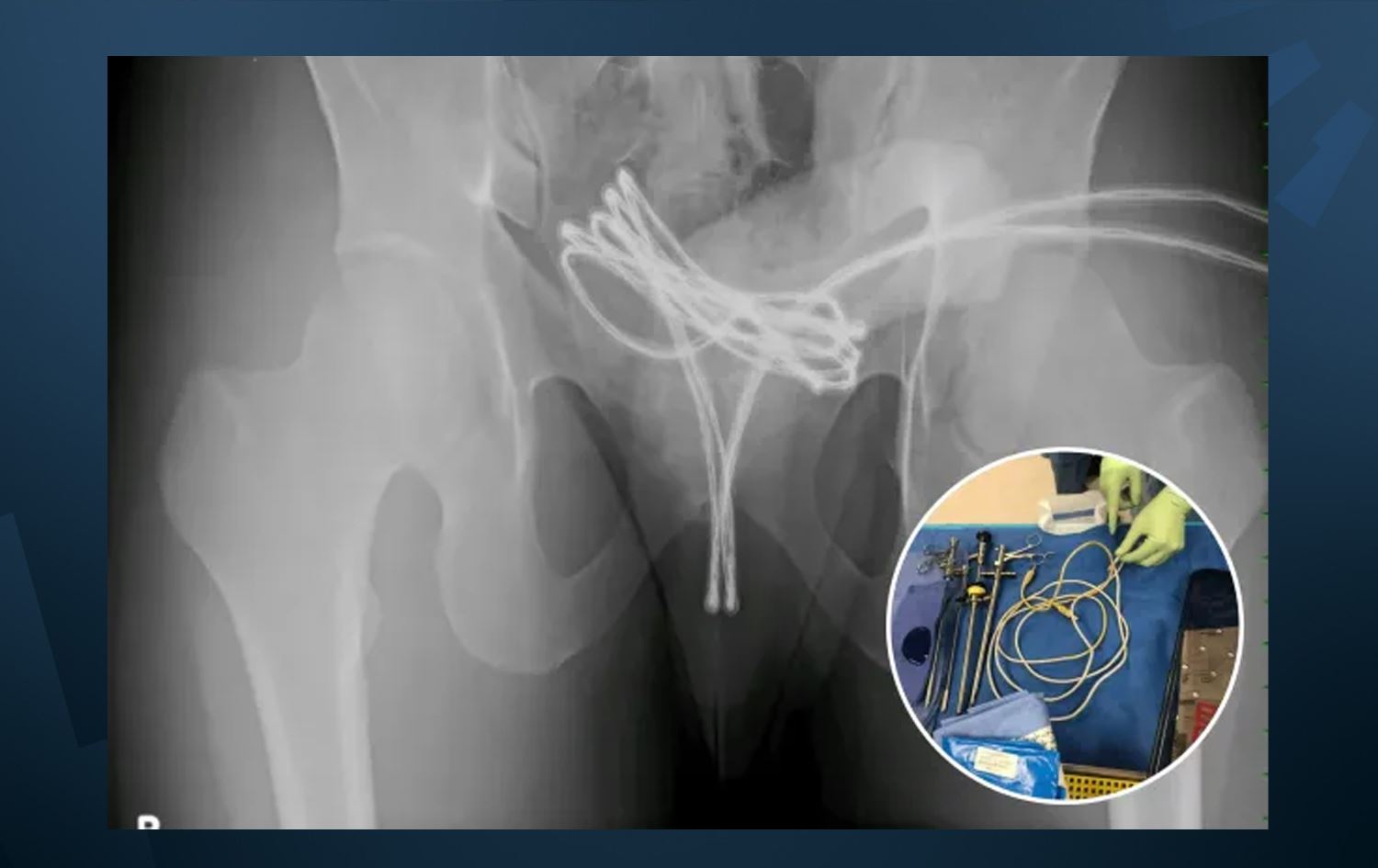 کێبڵێکی USB لە میزەڕۆی گەنجێکدا دەردەهێنرێت