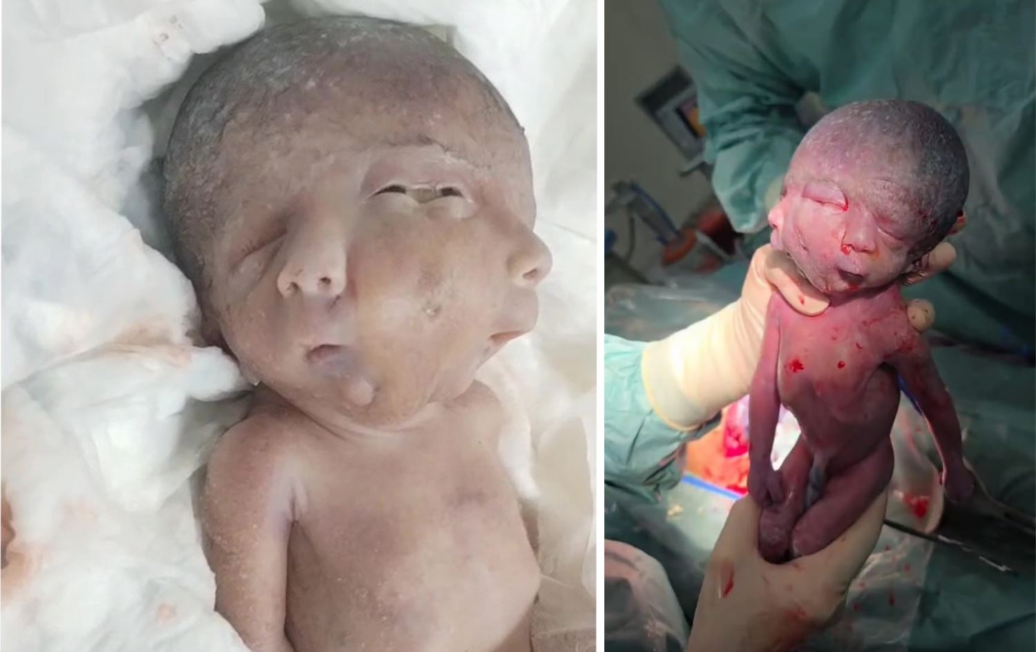 بە ڤیدیۆ؛ لە هەولێر منداڵێک بە دوو رووخسارەوە لەدایک بوو