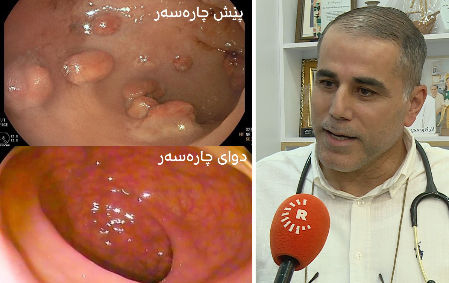 لە هەرێمی کوردستان و عێراق نەخۆشییەکی دەگمەن تۆمار و چارەسەر دەکرێت