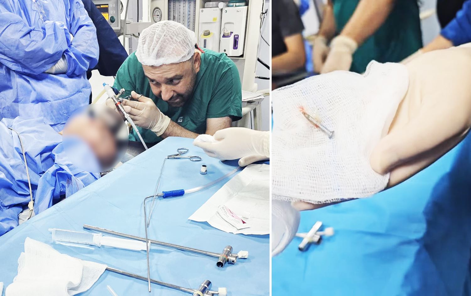 بە وێنە؛ بزمارێک لەنێو بۆڕیی هەناسەی منداڵێکدا دەرهێنرا