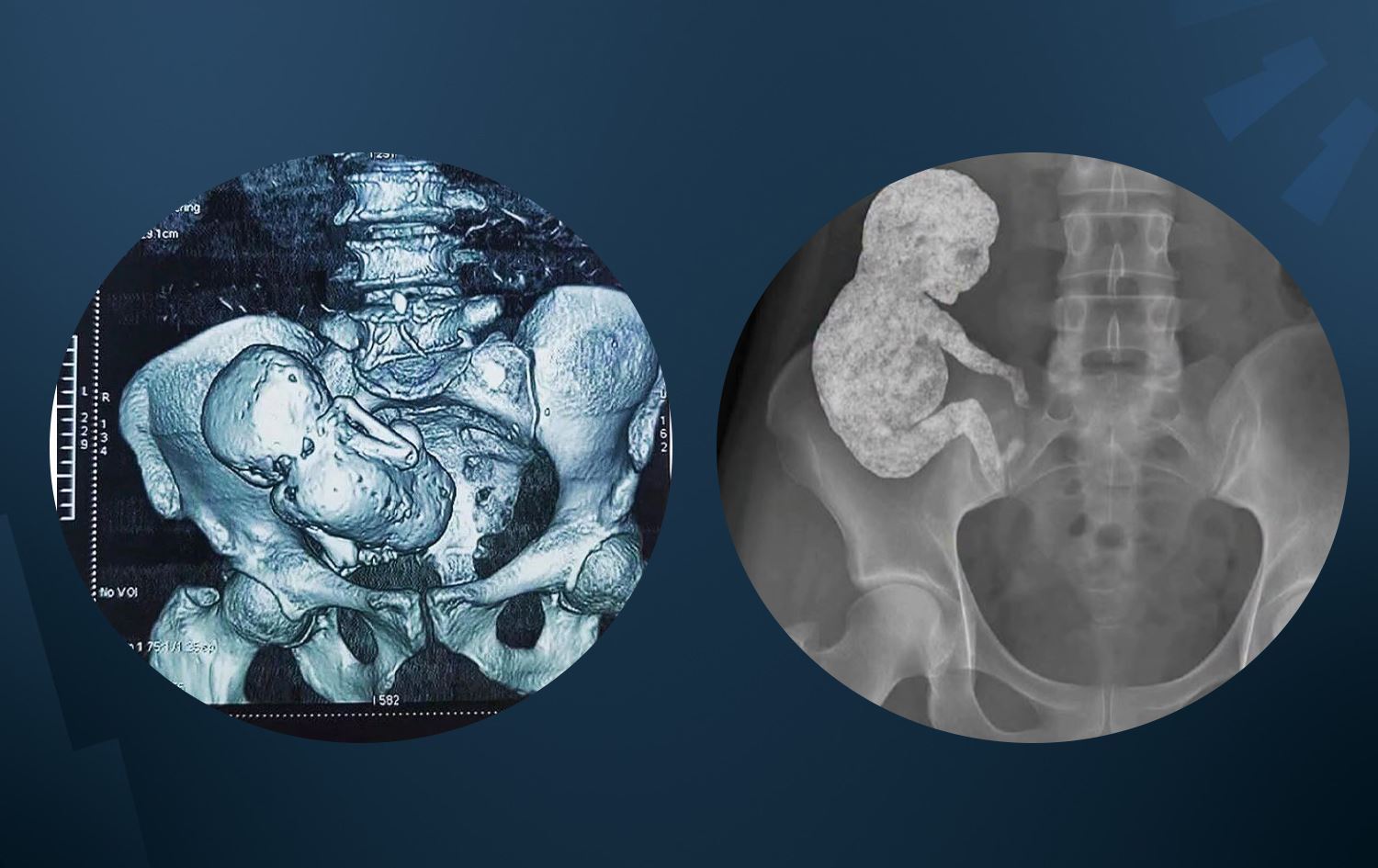 Yaşlı bir kadın, şiddetli karın ağrısı şikayetiyle gittiği hastanede 40 yıldır karnında taşıdığı kireçlenmiş bir fetüsle (taş bebek) yüzleşti