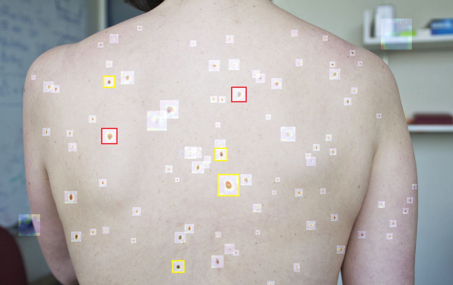 لە ئوسترالیا ژیریی دەستکرد بۆ زوو دەستنیشانکردنی شێرپەنجەی پێست تاقیدەکرێتەوە