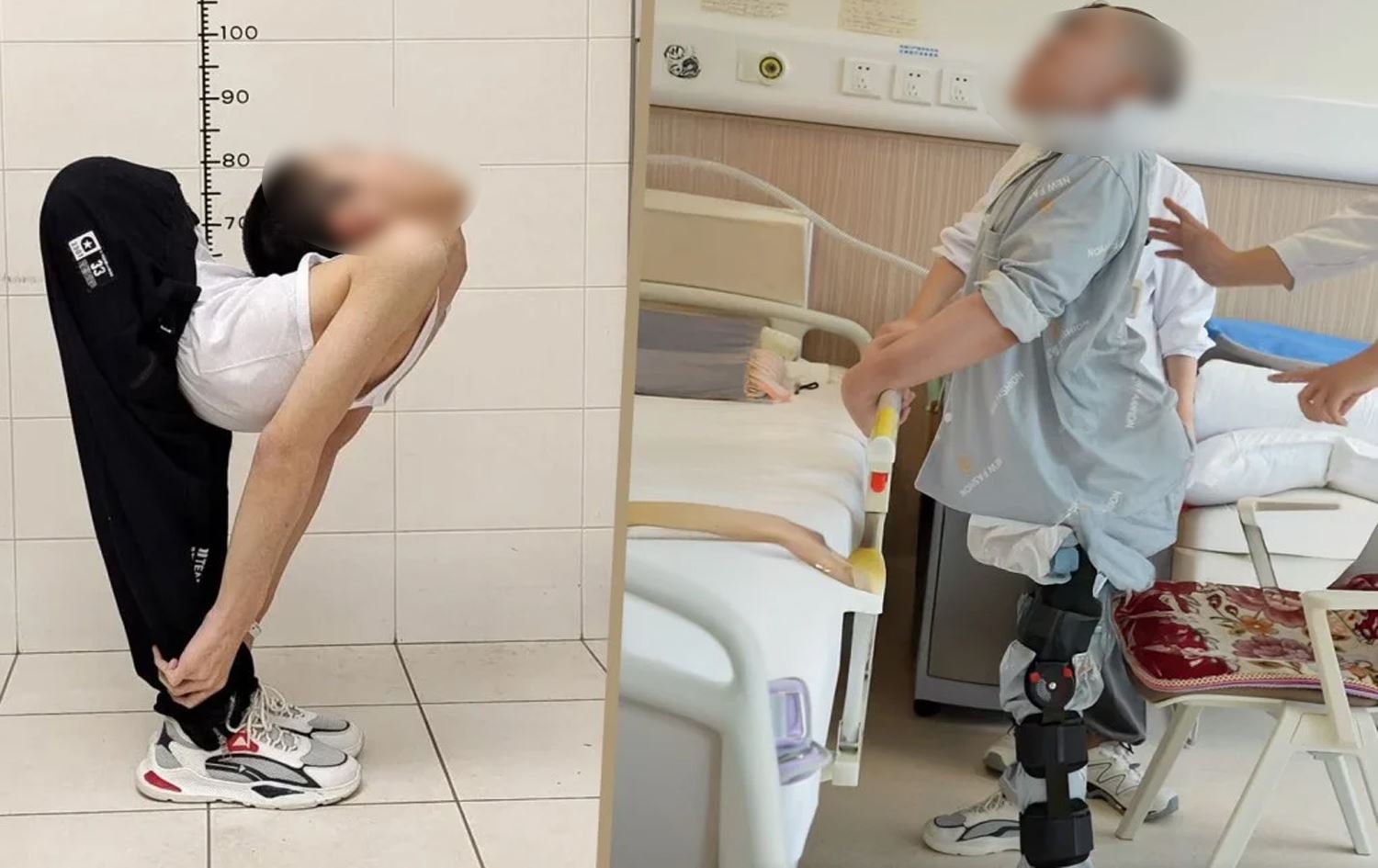 لە چین چارەسەری جەستەی چەماوەی سکماکیی گەنجێک دەکرێت