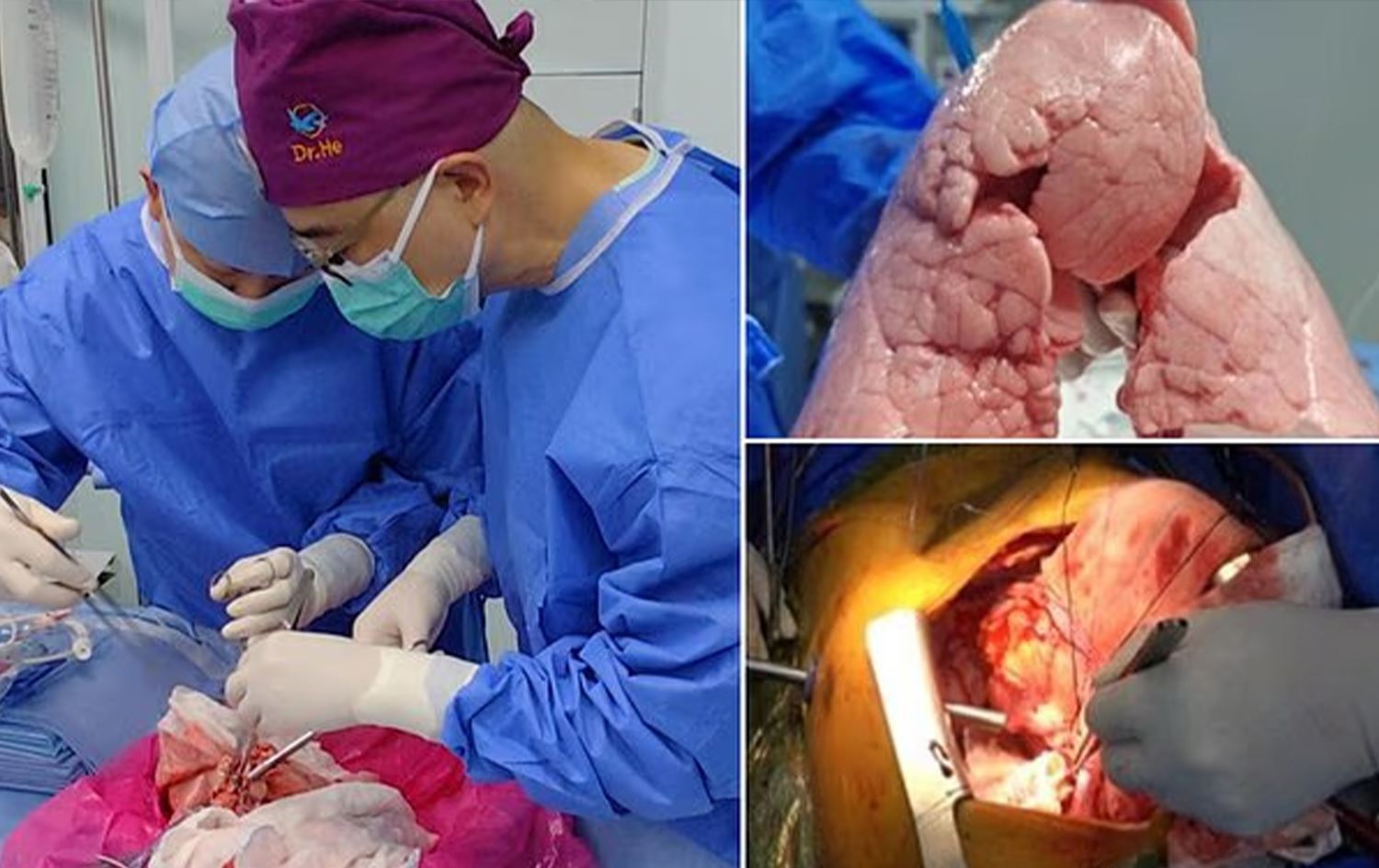 Çin tıbbında bir ilk: Domuz akciğeri insana başarıyla nakledildi  