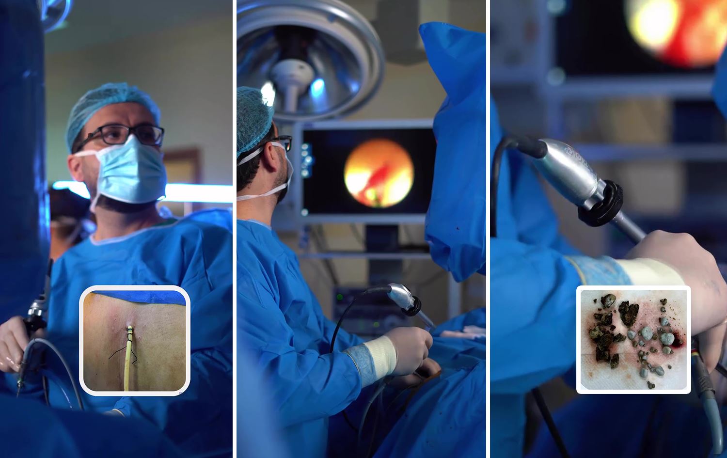 لە نەخۆشخانەی بلێ بە هەناوبینی چەندین بەردی گەورەی گورچیلە دەردەهێندرێن