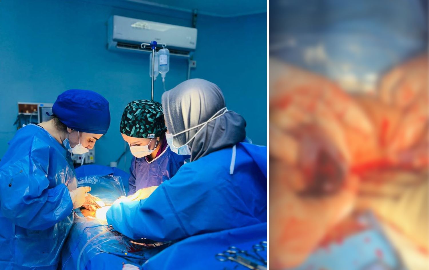 لە سۆران خانمێکی 17 ساڵ لە نەزۆکبوونی هەمیشەیی رزگار کرا