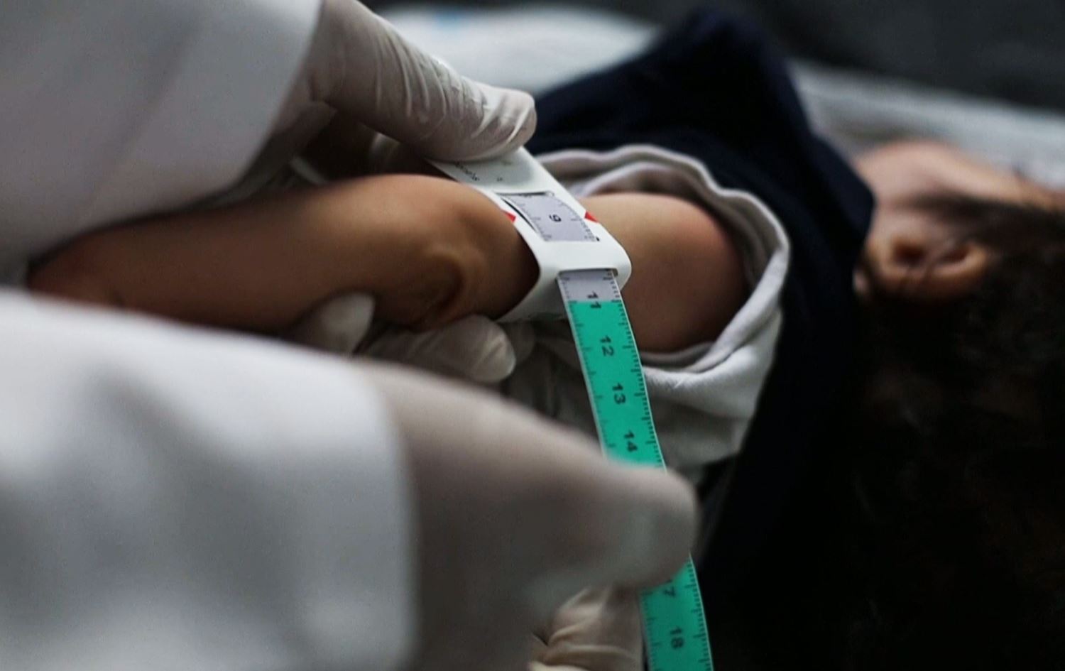 WHO: ئەم ساڵ لە غەززە 400 کەس بەهۆی بەدخۆراکییەوە گیانیان لەدەستداوە