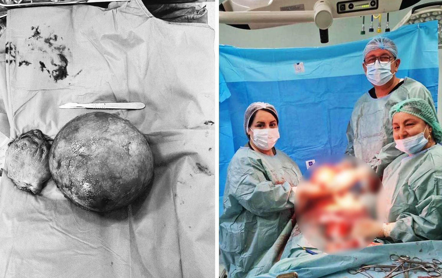 Erbil’in Koye ilçesinde ameliyata alınan genç bir kadının rahminden 25 santimetrelik dev bir tümör alındı