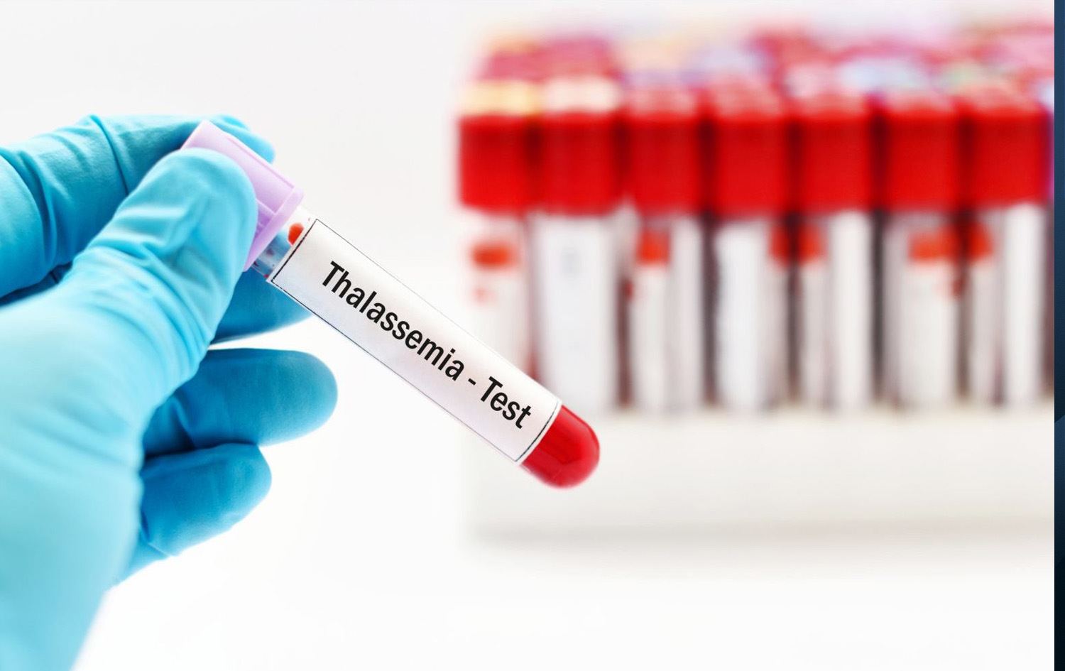 پشکنینی تالاسیمیا.