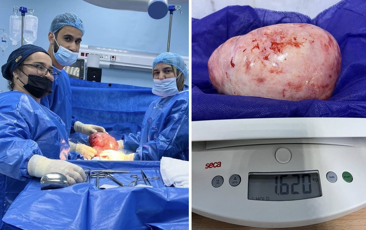 کاتی دەرهێنانی گرێیەکە. وێنە: نەخۆشخانەی لەدایکبوون و منداڵانی سۆرانی فێرکاری